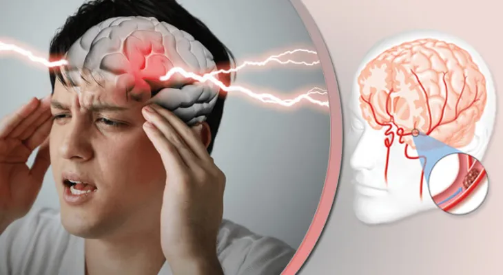 ۸۰ درصد از سکتههای مغزی قابل پیشگیریاند